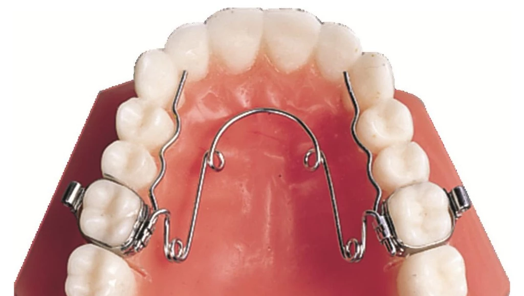Quad Helix regulering på tenner i overkjeve