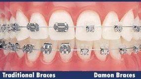 Tenner med Damon braces på den ene siden og tradisjonell tannregulering på den andre